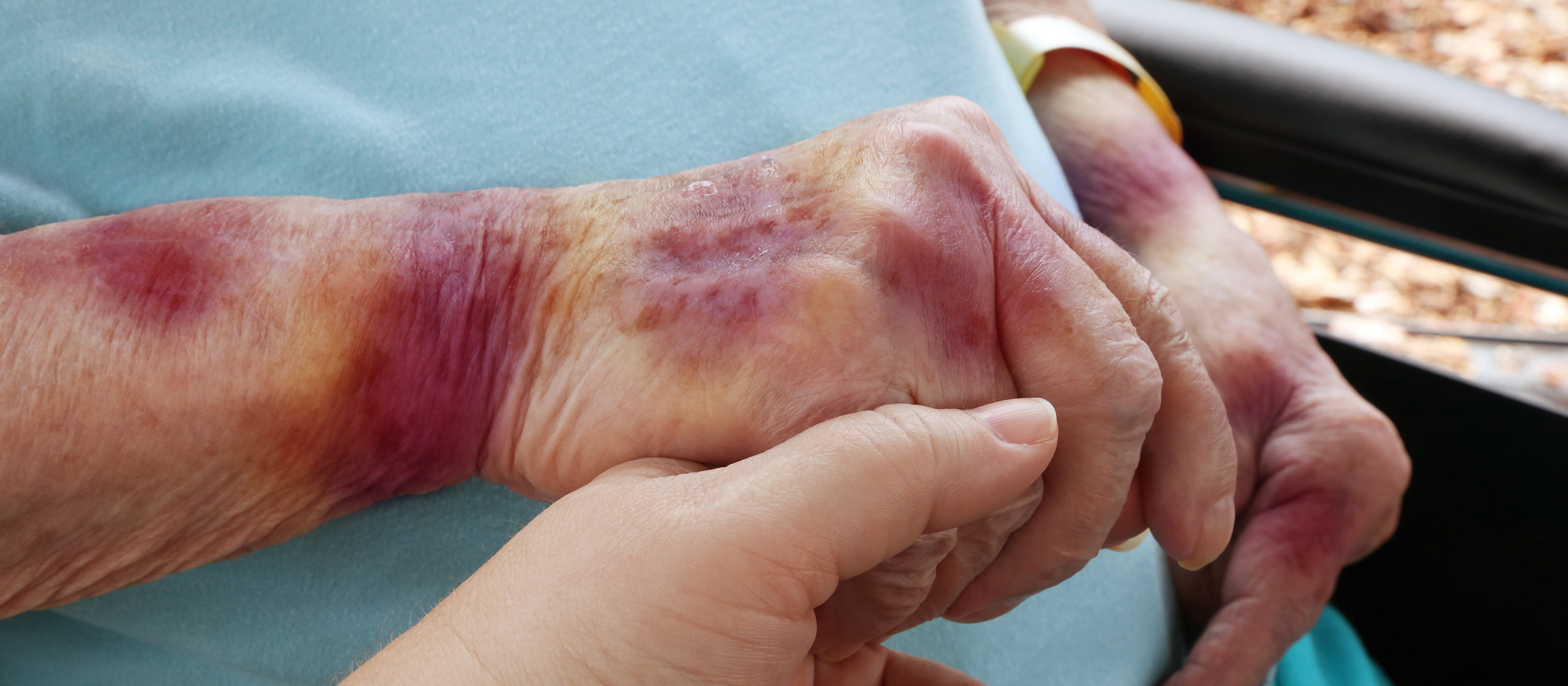 Dean Burnetti Discusses Aspects of Nursing Home Abuse