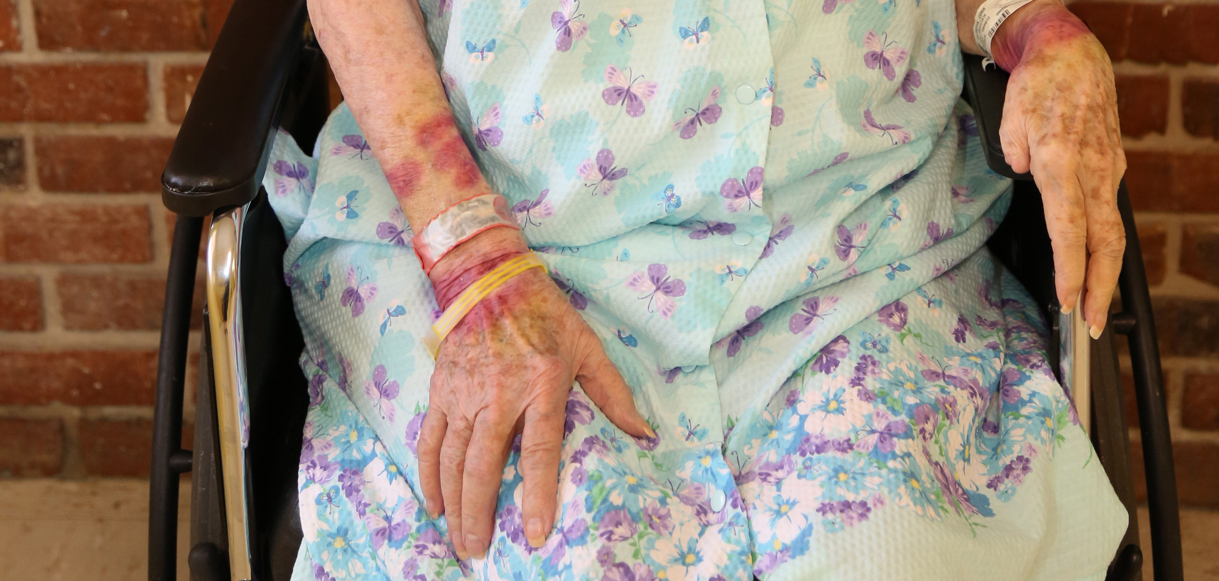 Dean Burnetti Law, Polk County's Top Medical Malpractice Law Firm